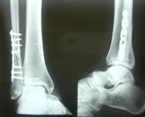 Raio-x após 3 meses , com fratura estabilizada com placa e parafusos